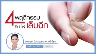  เล็บเปราะบางและฉีกขาดง่ายเกิดจากสาเหตุอะไรบ้าง 