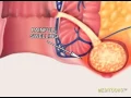 Download Lagu Anal Fistula - Meditoons™