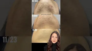 My clients beautiful electrolysis results