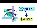 The One Diagram That Solves Every Park s 3-Step Test Bielschowsky Head Tilt Test