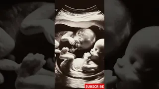 Twins in Ultrasound The Secret Life of Your Fetus