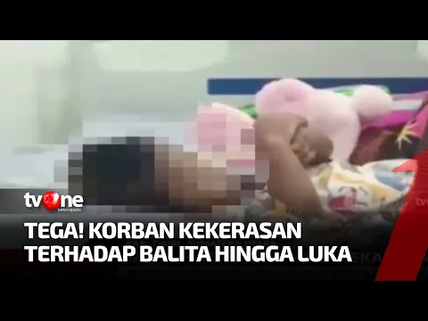 Kronologi Balita di Kab. Dairi Dianiaya Kekasih Ayah Hingga Alami Lebam di Kepala dan Sekujur Tubuh