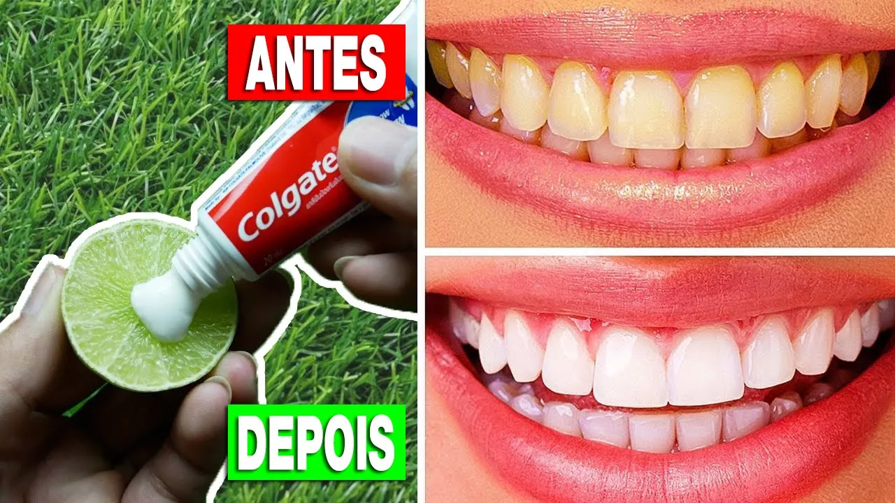 CLAREAMENTO TOTAL E RÁPIDO DOS DENTES