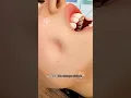 Download Lagu How Dimple Surgery Works 😲#short #dimpleplasty - Creativelearning3d
