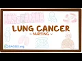 Lung Cancer Signs Symptoms Every Nursing Student Must Know