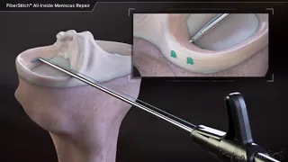 FiberStitch All-Inside Meniscus Repair