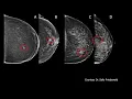 Screening Algorithms in Dense Breasts