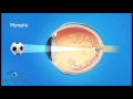 Refractive Errors