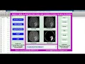 Brain Tumor Classification Using CNN With Source Code Matlab Project Brain Tumor Detection