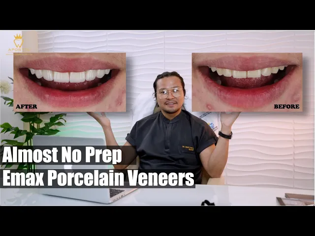 New Year New Smile with Emax Porcelain Veneers