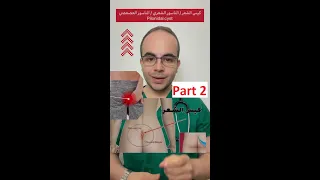                         كيف يتم علاج كيس الشعر أو والناسور العصعصي  دندنها