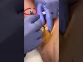 Download Lagu High pressure abscess POPPED! | 208SkinDoc