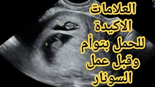 علامات الحمل بتوأم قبل عملةالسونار 