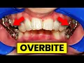 4 ways to correct your OVERBITE under 3mins Orthodontist Explains