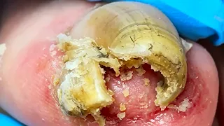 Roll The Tip Of Your Nail Into A Cylinder And Remove Any Dirt Inside【Xue Yidao】