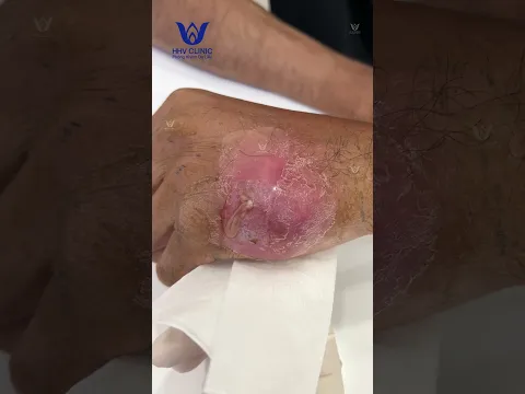 Mụn áp xe sưng viêm to, xì dịch mủ trắng