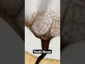How decay destroys your teeth 3D Animation