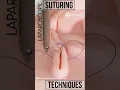 Laparoscopic Suturing Techniques