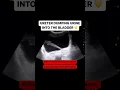 Download Lagu Ureter jetting urine into the bladder