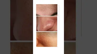 معرفة نوع البشرة الجزء الرابع البشرة المختلطة 