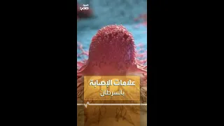 علامات الإصابة بالسرطان 