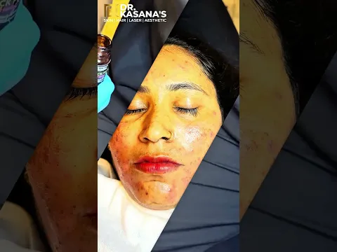 Blackheads removal treatment by Dr. lalit kasana #blackheads #blackheadsremoval