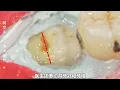 这颗智齿竟然横着长，完全埋进了牙龈里，简直不要太痛苦！！【悦贝电影】