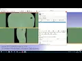 Tutorial for renal calculus volume estimation in 3D slicer