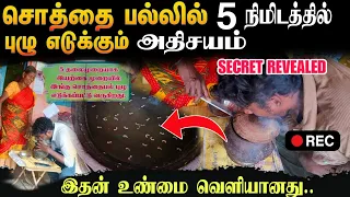 சொத்தைப்பல் புழு எடுத்தல் உண்மை வெளியானது | Viral video Truth | Edison vlogs tamil