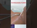Download Lagu Thyroidectomy Procedure #shorts