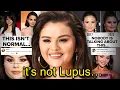 SELENA GOMEZ DESTROYED HER FACE irreversible damage