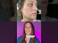 Accutane Transformation and Timeline