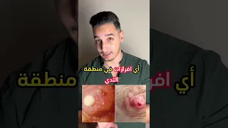 ما هي الأعراض المبكرة لسرطان الثدي و كيفية الكشف عنهم سرطان ثدي سرطان ثدى سرطان توعيه سرطان ثدي 