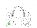 DYNAMIC OCCLUSION - Working vs Non-working Movement Occlusal Grid