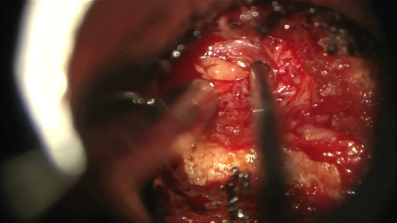 Surgical step by step demonstration of a full endoscopic resection of a L5-S1 disk herniation and bo. 