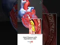 Download Lagu How Does Heart Bypass Surgery Work? ↪ 3D Medical Animation #Shorts #SaphenousVein