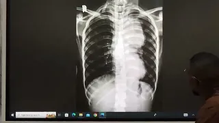 Neuro Trauma 3 Surgery د حسن خيري اينشتاين القصر العيني 