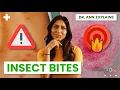 Insect Bites How to Tell What Bit You Pictures When to Worry