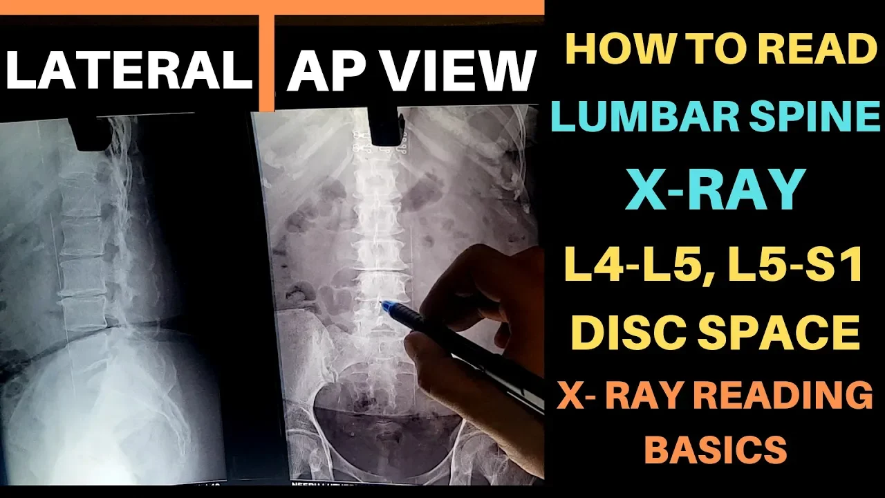 Radiological Anatomy of the Lumbar Spine: X-ray, MRI & CT Covered. 