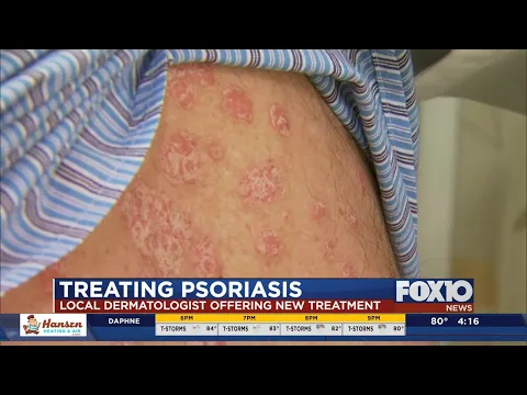 Download MP3 New treatment for psoriasis