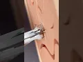 Skin Stapling and Removal