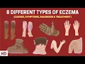 Eczema Exposed 8 Types You Need to Know