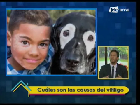 Por qué se produce el vitiligo