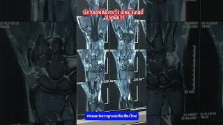  ทำไมนักกอล์ฟถึงเจ็บที่ฝ่ามือหลังตีลูกกอล์ฟแล้วไม้โดนบังเกอร์ 