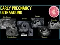 Early Pregnancy Ultrasound A Deep Dive into First Trimester Insights