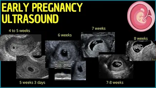 early pregnancy ultrasound a deep dive into first trimester insights pregnancyultrasound