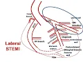 ECG course Culprit in Lateral STEMI Dr Sherif Altoukhy