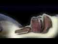 ResMed - What is obstructive sleep apnea