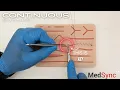Continuous Suture The Fastest Method