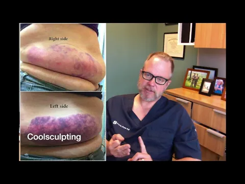 Download MP3 Sculpsure vs Coolsculpting - Which One is Better?